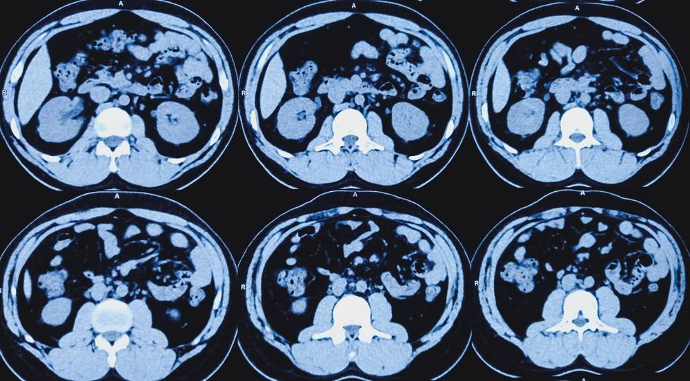 Abdomen Ct Scan Pancreas Cancer